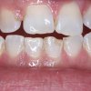 Lower Chipped Tooth Before